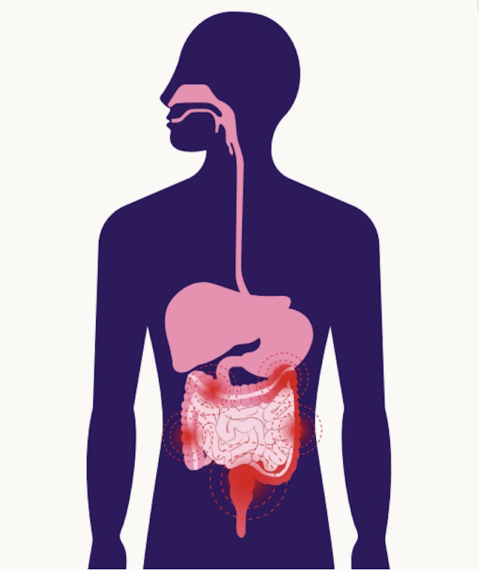 About Ulcerative Colitis – Crohn's & Colitis Australia (CCA)