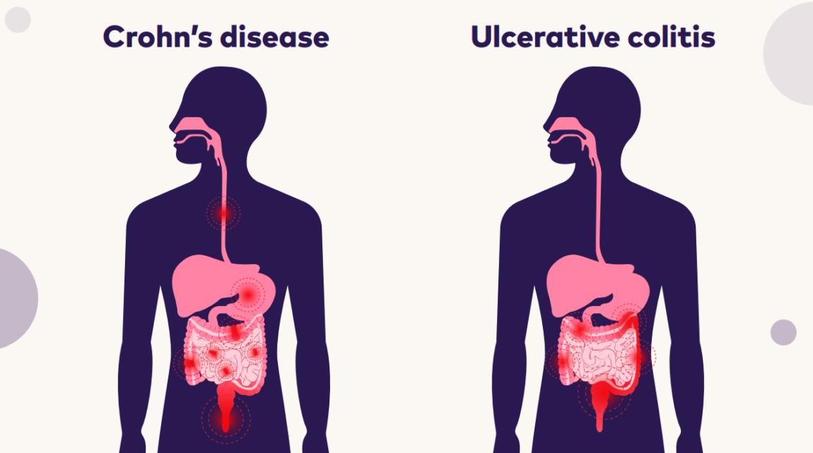 Crohn's And Colitis Kids – Crohn’s & Colitis Australia (CCA)