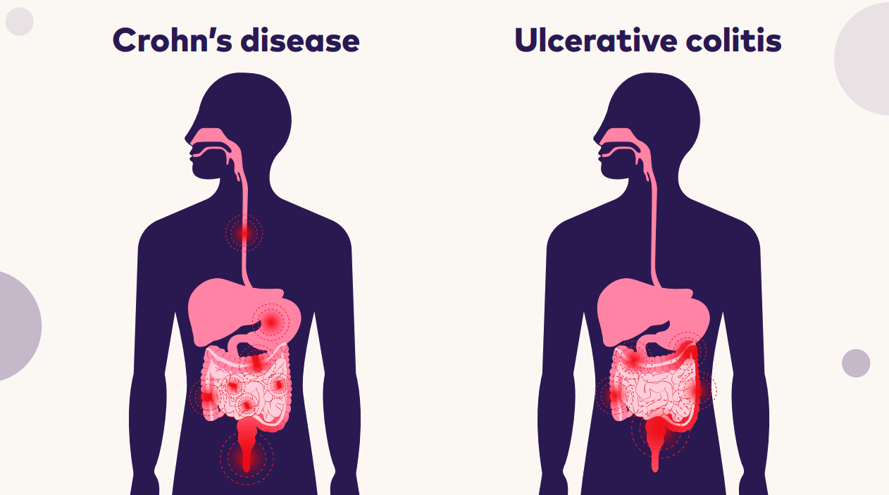 Crohn's and Colitis Kids – Crohn’s & Colitis Australia (CCA)